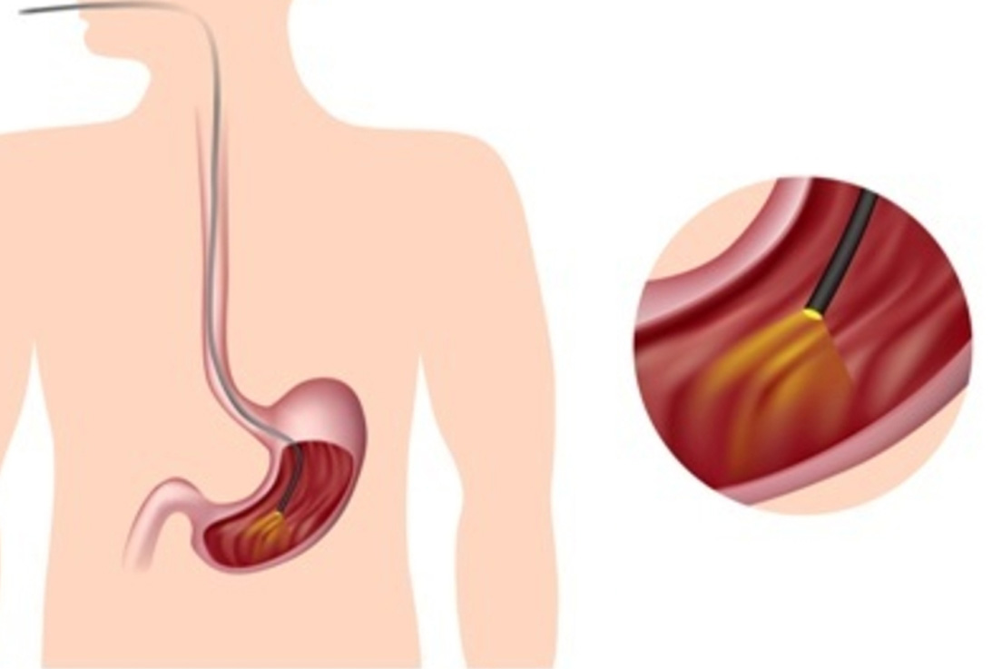 Antroduodenal Endoscopy