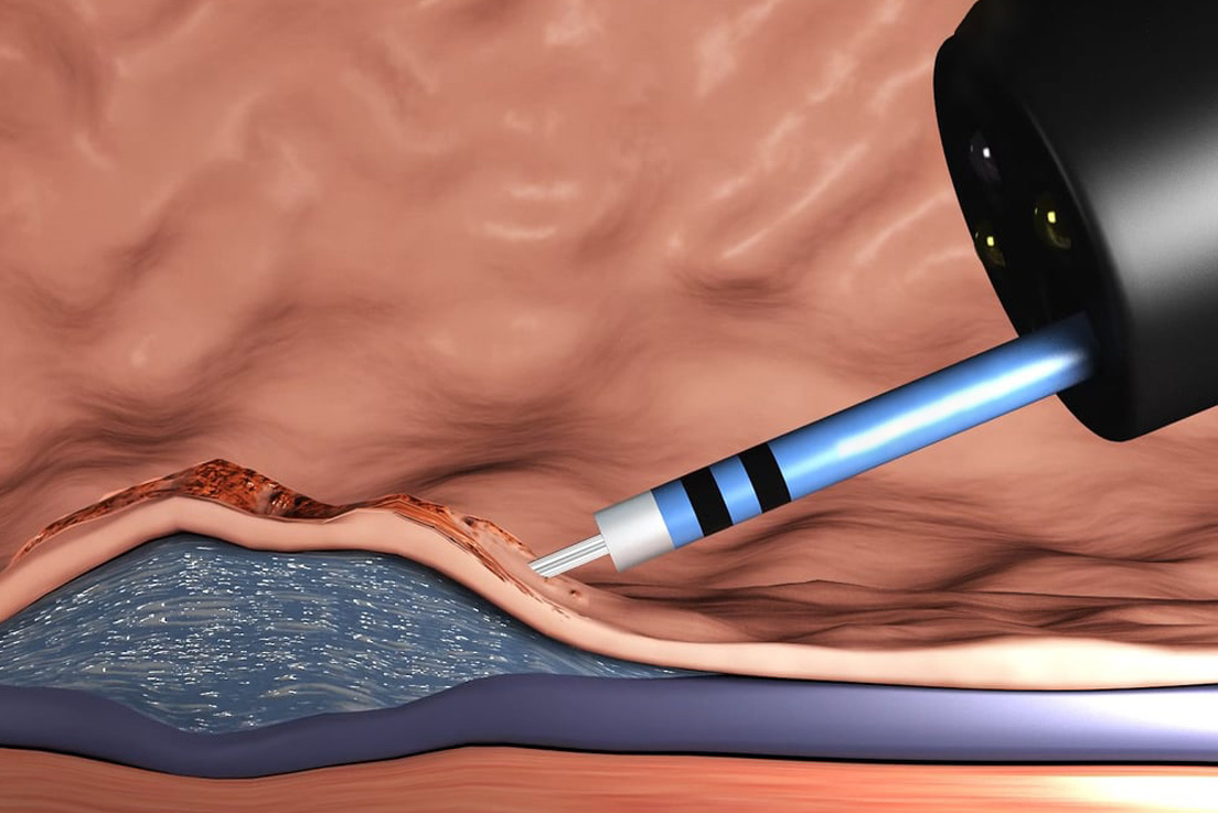 ESD (Endoscopic Submucosal Dissection)