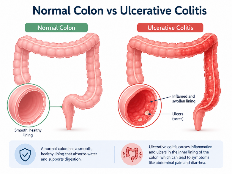 Illustration showing inflammation and ulcers in the lining of the colon in ulcerative colitis.